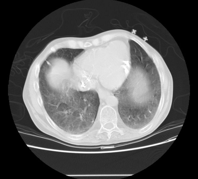 File:Metastatic pulmonary calcification 105.jpg