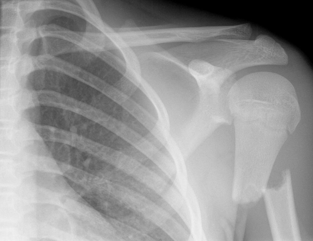 Transverse fracture through the proximal diaphysis of the left humerus, with complete displacement and slight overlap. Open growth plate noted.