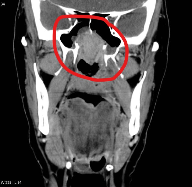 File:Nasopharyngeal carcinoma CT 3.jpg