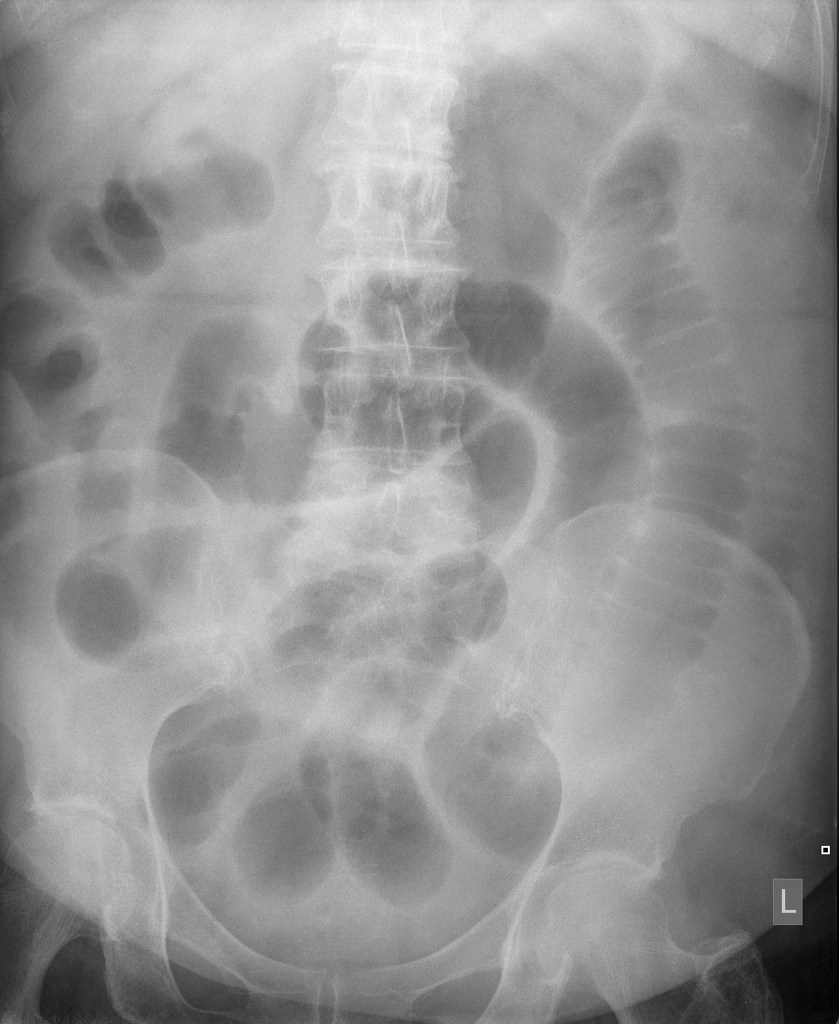 File:Small-bowel-obstruction-12.jpg