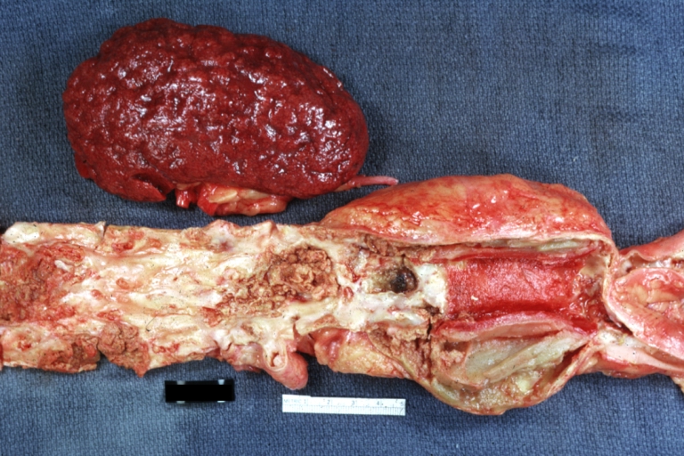 Kidney: Atheromatous Embolus: Gross, natural color, external view of kidney with typical scarring pattern of repeated infarction and aorta with severe atherosclerosis (quite good example)