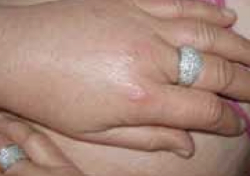 Edematous polyarthritis of the hands