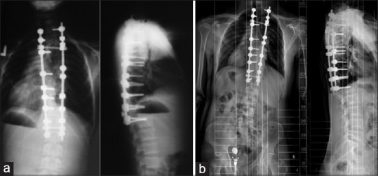 File:Aarskog-Scott syndrome X-ray.jpg