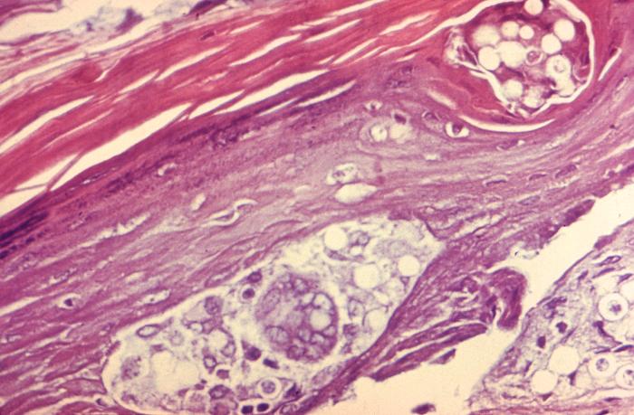 This photomicrograph reveals some of the ultrastructural histopathology in an dermal skin tissue specimen in a patient with an intradermal keloidal blastomycosis infection, which had been long standing, and resulted in a chronic granulomatous inflammatory response. From Public Health Image Library (PHIL). [2]