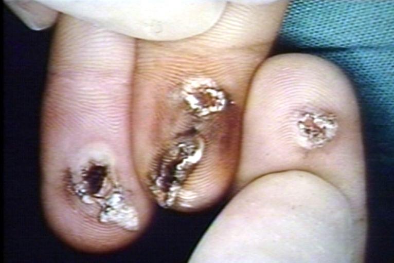 Skin: Trauma wound electrical; skin: electrical burns on fingers