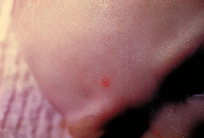 4-month old infant with skin lesions on his brow ridge due to chickenpox. From Public Health Image Library (PHIL). [27]