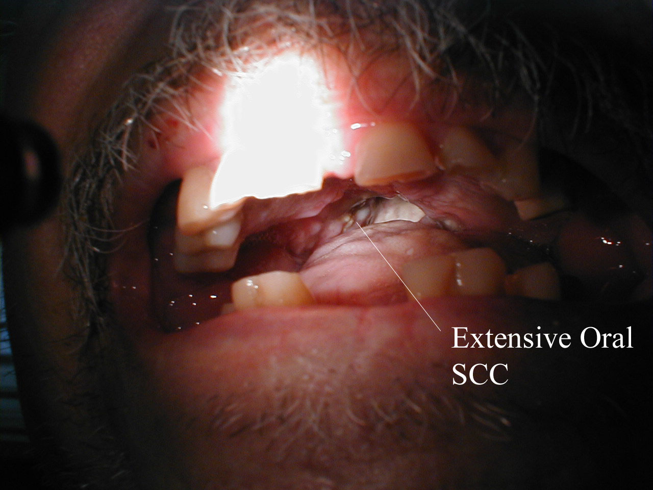 Squamous Cell Cancer of the Mouth: Irregular, necrotic appearing tissue on the inside of the mouth due to extensive squamous cell cancer. Patient has limited ability to open his mouth (aka trismus) as a result of the infiltrating cancer.