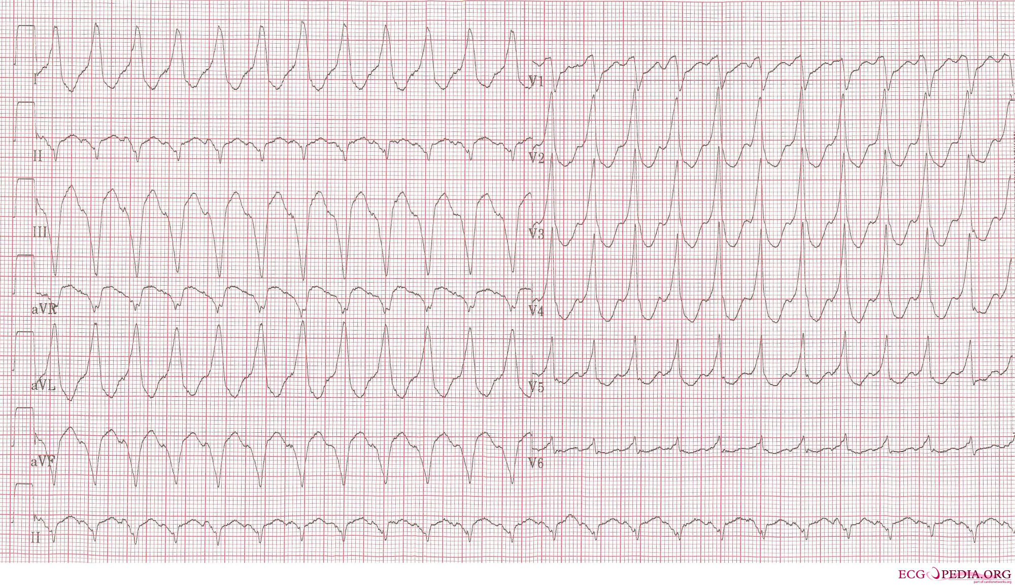 Ventricular tachycardia of 140 bpm with a left bundle branch block pattern and left heart axis.