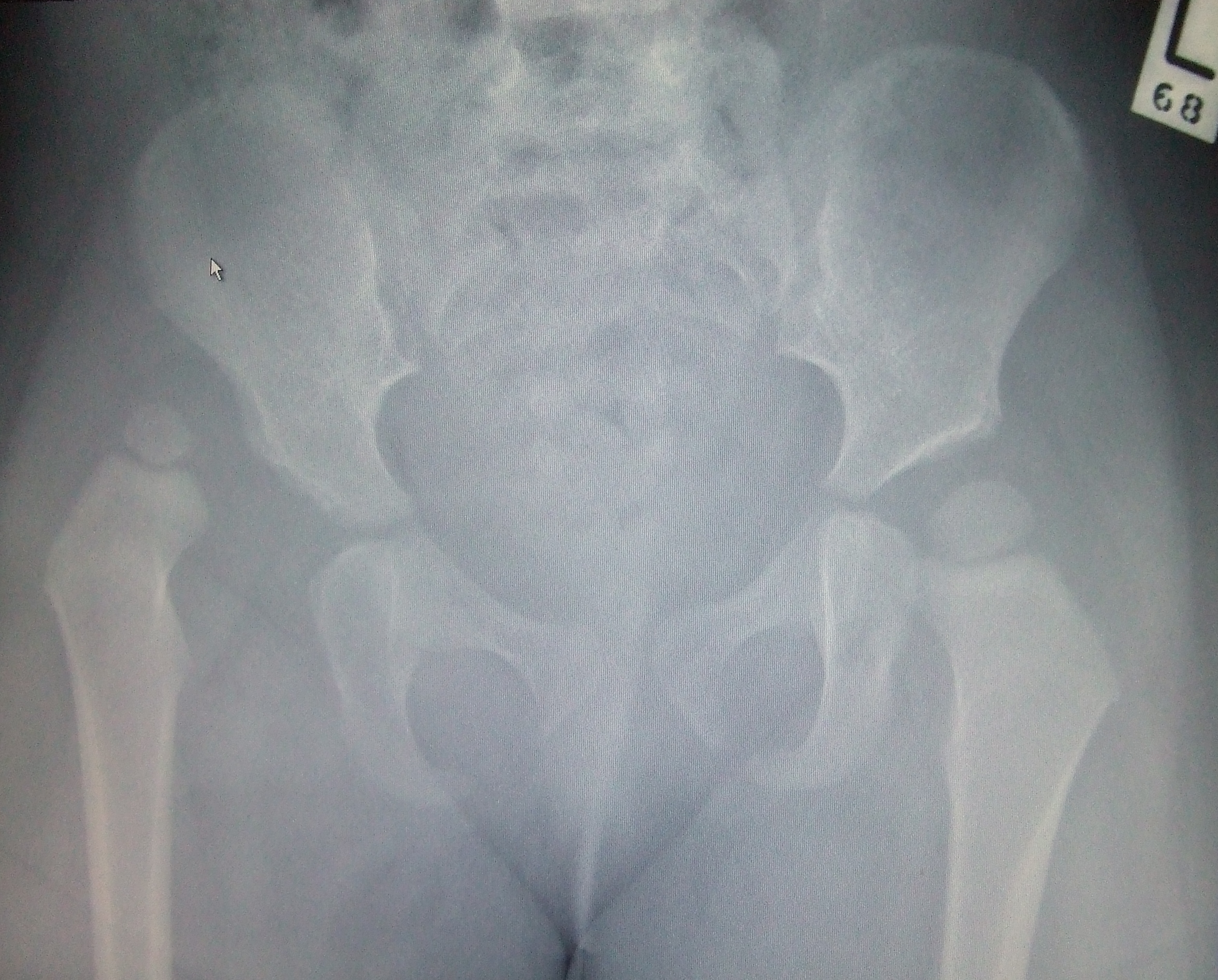 File:Dislocated hip.jpg
