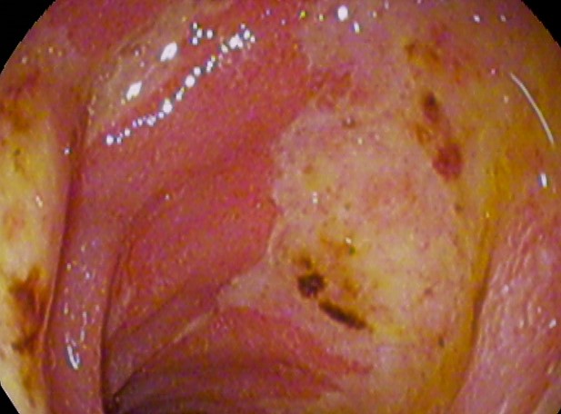 Duodenal ulcer specimen. Source: https://commons.wikimedia.org/wiki/File:Duodenal_ulcer01.jpg#/media/File:Duodenal_ulcer01.jpg