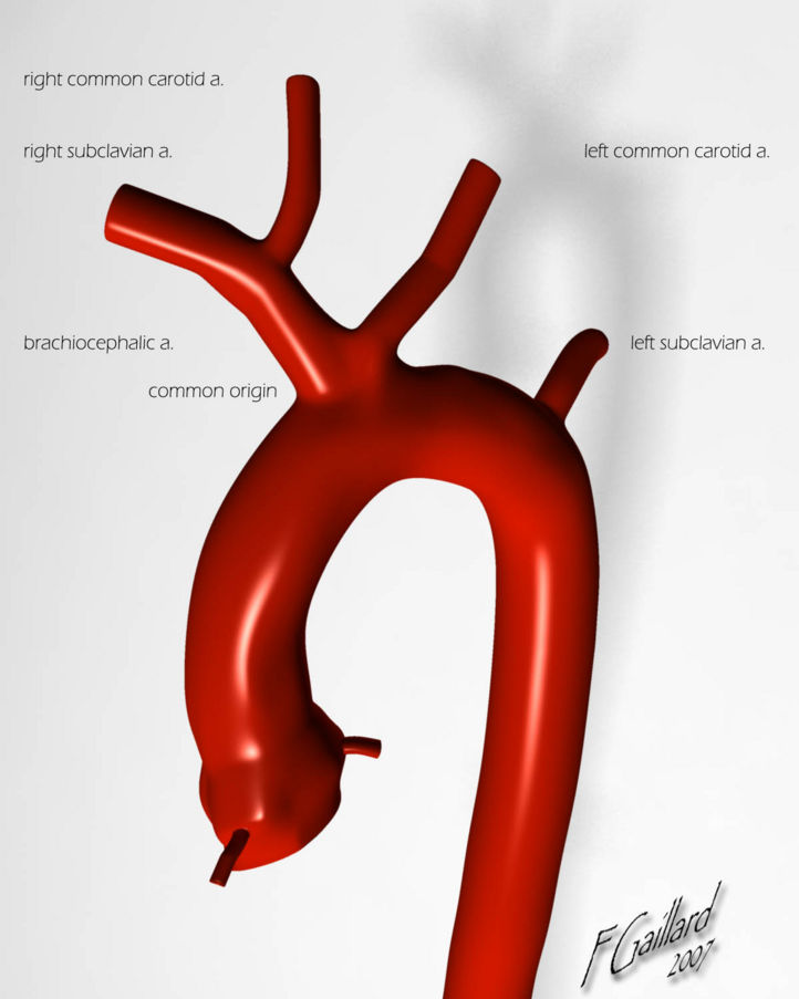 Aortic variations: Bovine arch