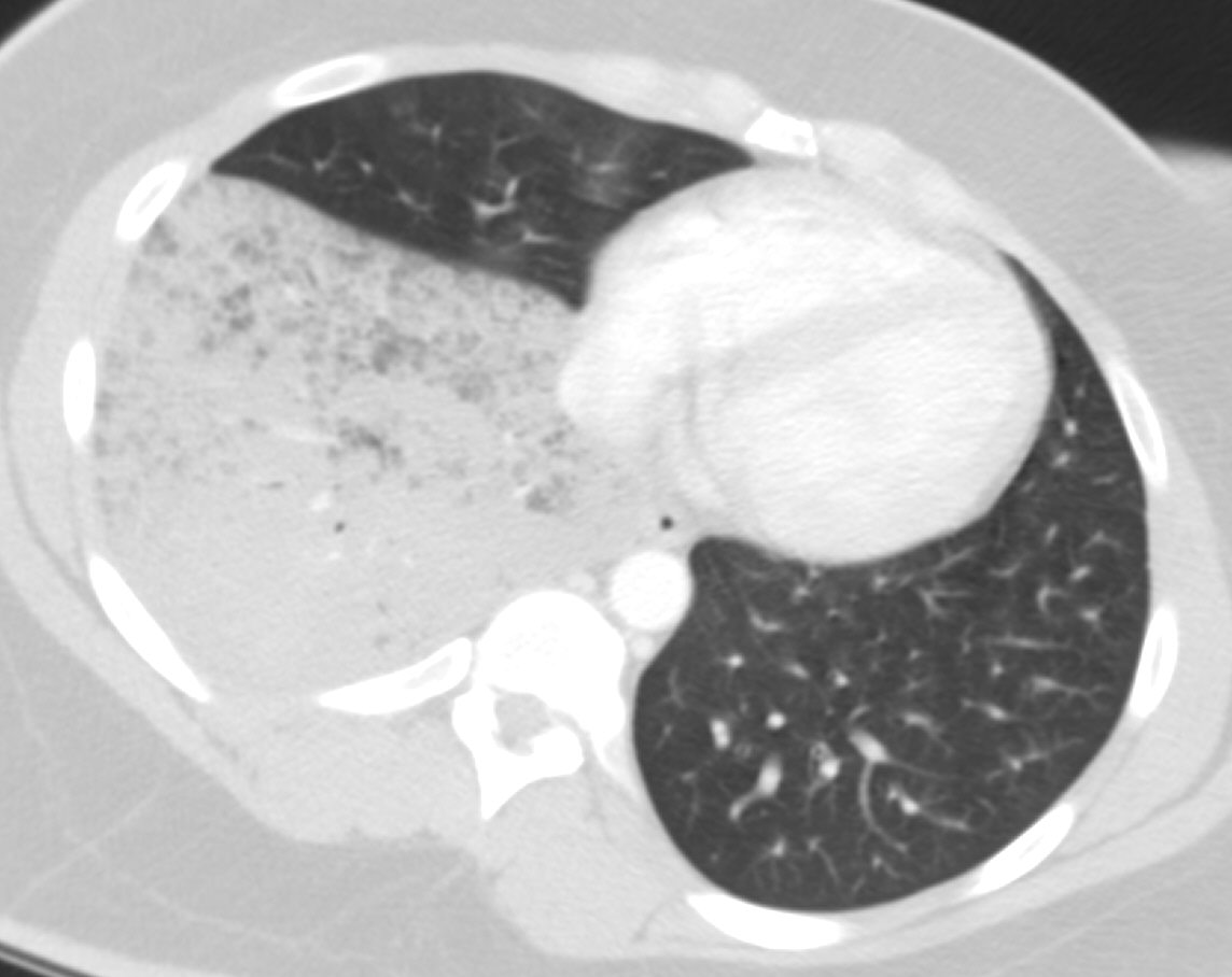 CT: Another patient with bronchoalveolar carcinoma (Image courtesy of RadsWiki)