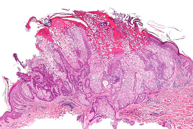 Micrograph of a sebaceous adenoma, as may be seen in Muir-Torre syndrome.