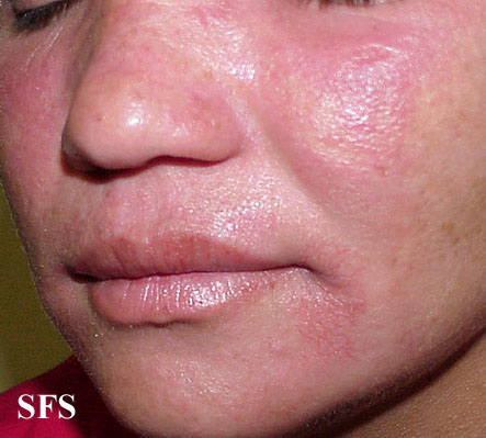 File:Nail polish dermatitis13.jpg