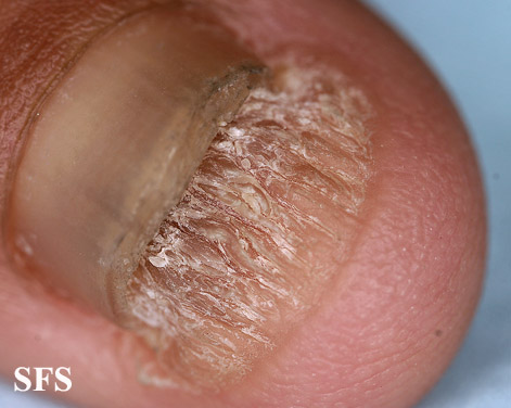 Onychomycosis. With permission from Dermatology Atlas.[4]