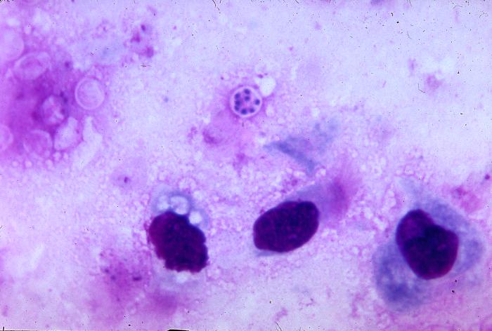 Pneumocystis jiroveci is present in this lung impression smear, using Giemsa stain