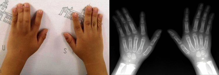 File:Syndactyly in Timothy syndrome (TS) .gif