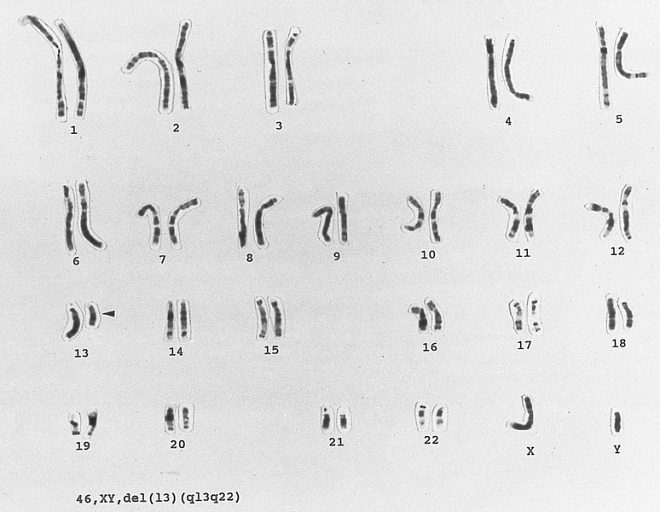 Chronic Lymphocytic Leukemia: 13q-chromosome abnormality karyotype of a lymphocyte from a patient with newly diagnosed B CLL. There is a clonal abnormality involving partial deletion of the long arm of chromosome 13 at bands q13q22. (G-banded, Wright-Giemsa stained)