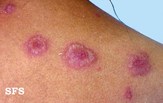 Erythema multiforme Adapted from Dermatology Atlas.[1]