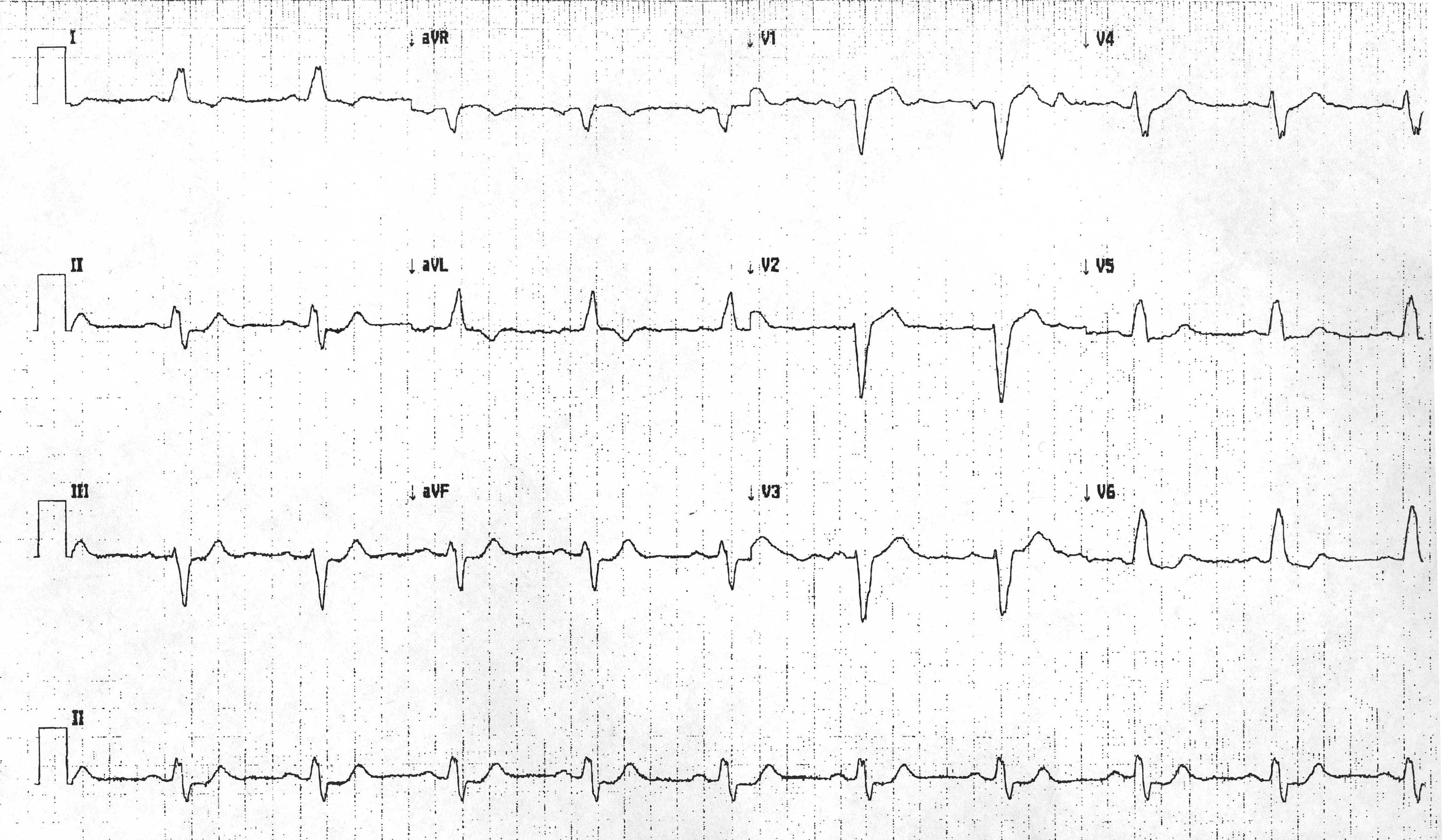 File:LBBB with pseudonormalization of T waves.jpg