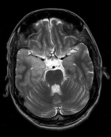 VZV Encephalitis MRI T2