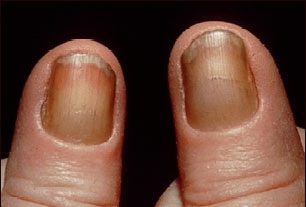 File:Yellow nail syndrome.jpg