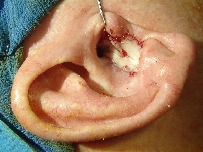 The tumor was removed and the defect closed with a full thickness skin graft (FTSG) from the neck[5].