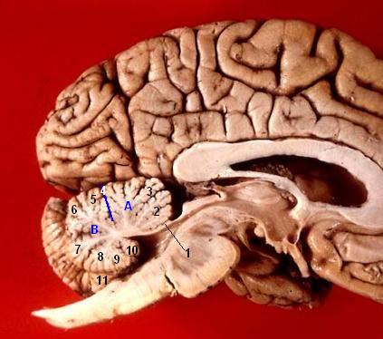 Human brain midsagittal view