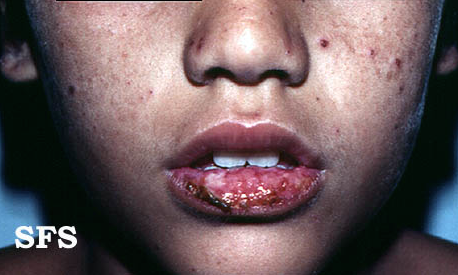 url = http://www.atlasdermatologico.com.br/disease.jsf?diseaseId=194>