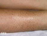 Ichthyosis Vulgaris. With permission of the Dermatology Atlas