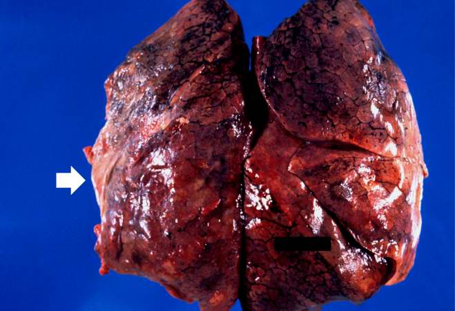 File:Lung fibrosis case 001.jpg