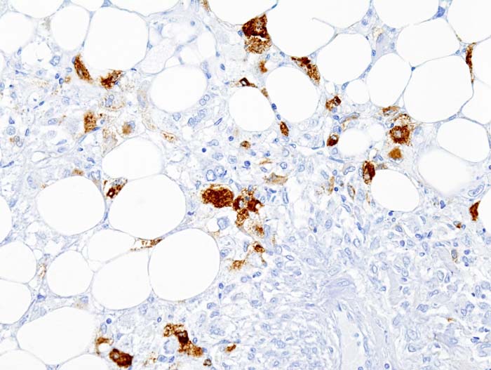 Histopathologic image of renal angiomyolipoma. Nephrectomy specimen. HMB-45 immunostain.[12]