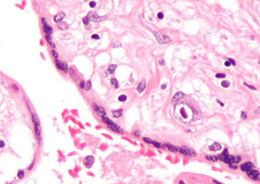File:CMV placenta.jpg