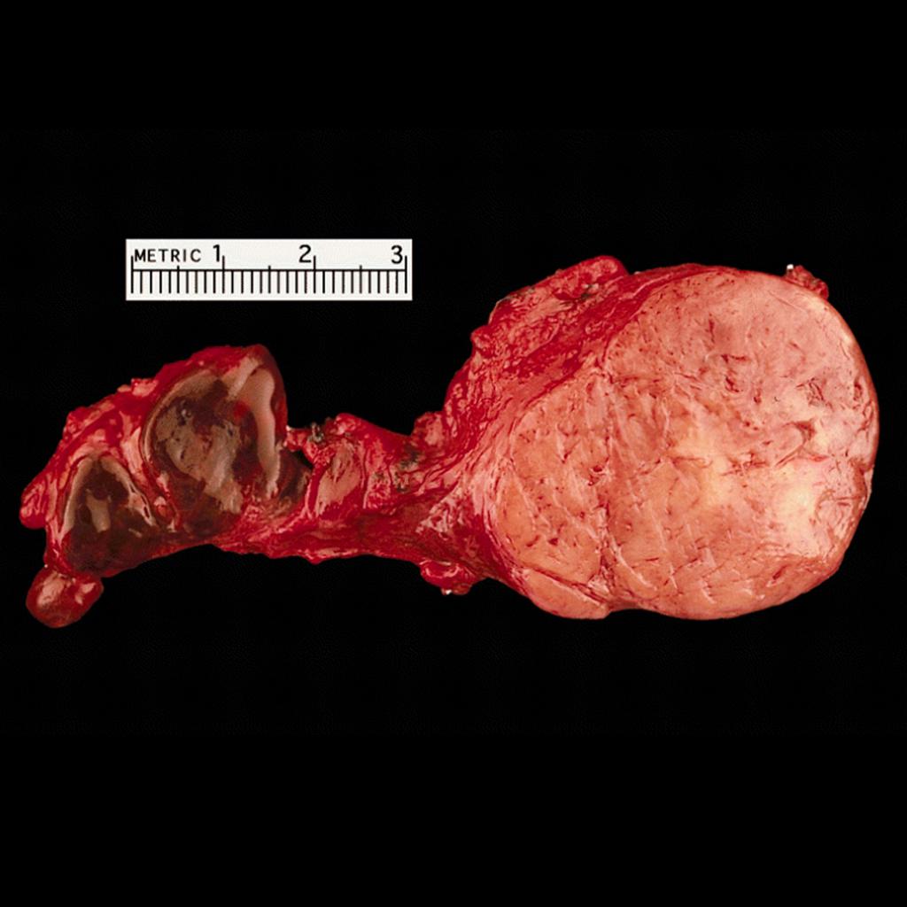 Gross pathology of carotid body tumor[3]