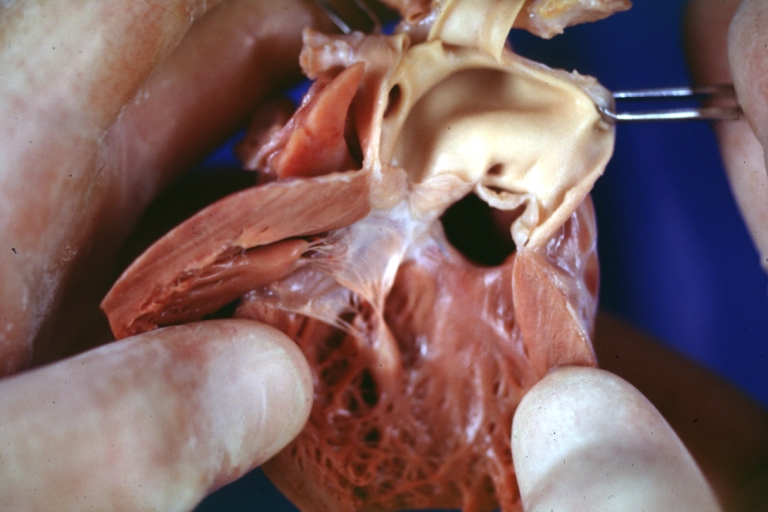 Truncus Arteriosus with Subvalvular Ventricular Septal Defect: Gross, natural color, an excellent view of subvalvular defect. Quadricuspid truncus valve and type I origin of pulmonary arteries