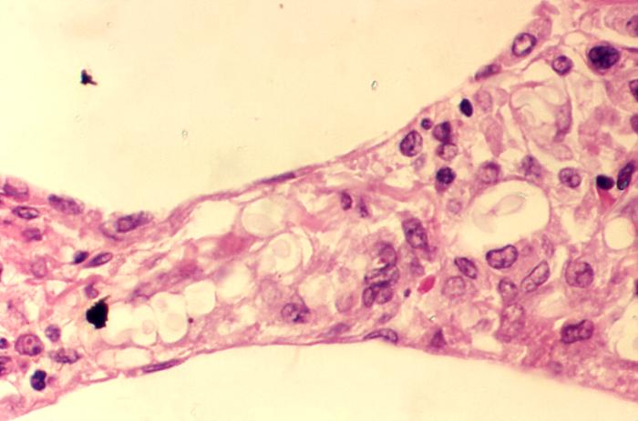 Cryptococcosis of lung in patient with AIDS. From Public Health Image Library (PHIL). [10]