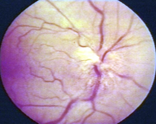 Fundoscopy: Eye; Optic Nerve Glioma, Optic Nerve