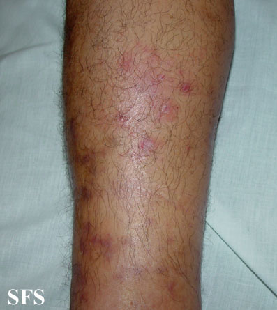 kaposi's sarcoma. Adapted from Dermatology Atlas.[3]