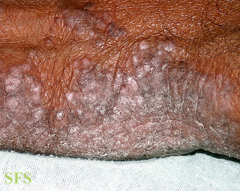 File:Pityriasis rubra pilaris72.jpg