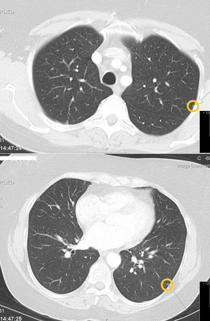 File:Pulmonary Nodule CT.png