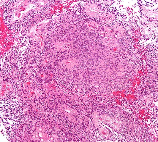File:532px-Ependymoma low intermed mag.jpg