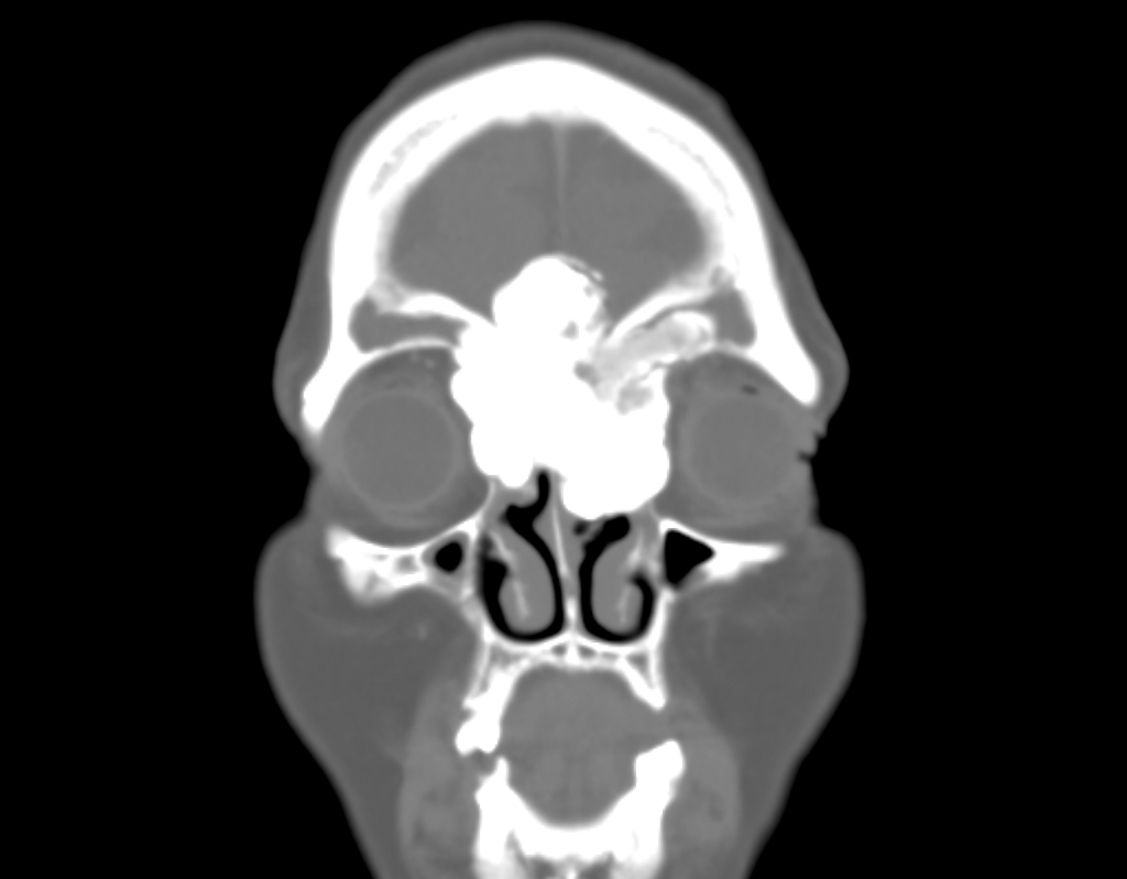 Coronal view exophytic osteoma[1]