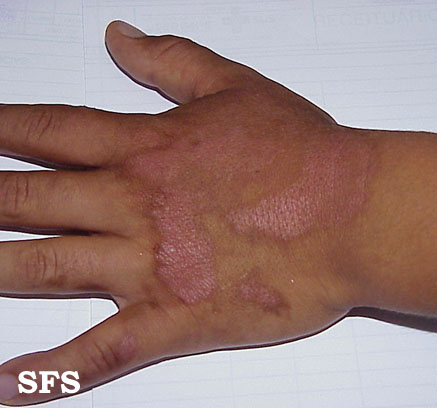 Phytophotodermatitis. With permission from Dermatology Atlas.[21]