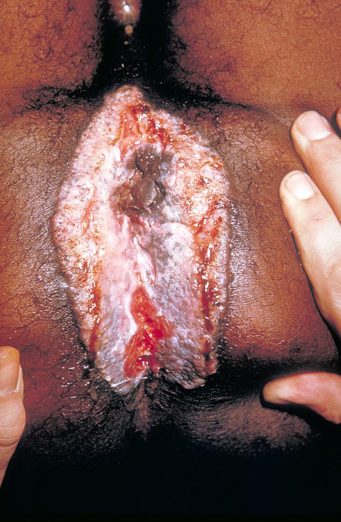 Granuloma inguinale, or Donovanosis, accompanied by perianal skin ulceration due to the bacterium, Klebsiella granulomatis. Adapted from Dermatology Atlas.[4]