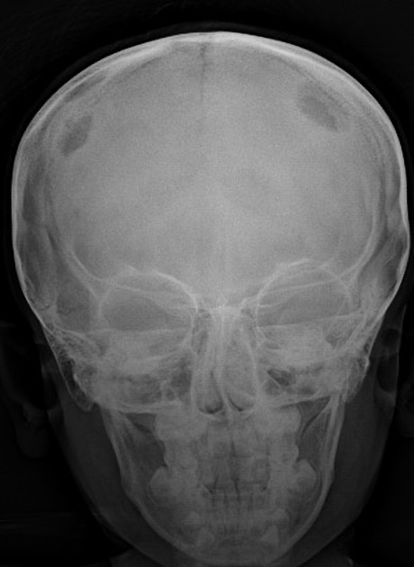 Geographic skull sign: radiographic appearance which is seen at eosinophilic granuloma. Destructive lytic bone lesion, edges of which may be bevelled, scalloped or confluent Adapted from Radiopedia