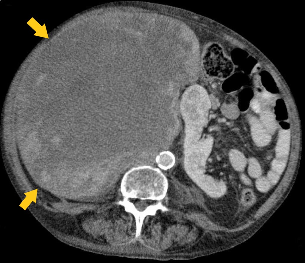 File:Retroperitoneal Liposarcoma CT.jpg