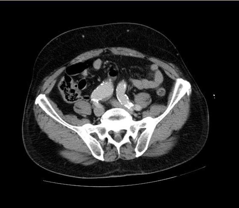 CT: a large abdominal aortic aneurysm