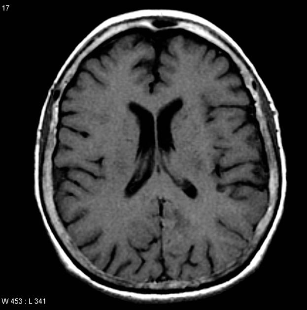 Axial T1 MRI of gliomatosis cerebri.[3]