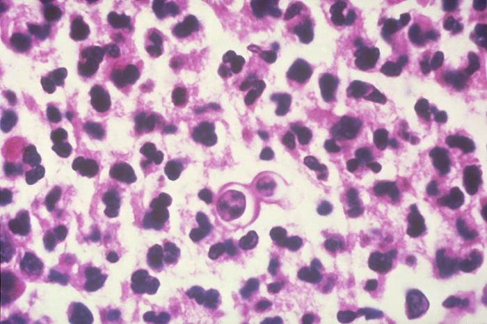 Histopathology of blastomycosis of skin. Budding cell of Blastomyces dermatitidis surrounded by neutrophils. From Public Health Image Library (PHIL). [26]