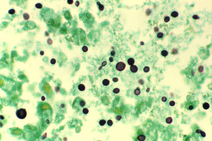 Cryptococcosis of lung in patient with AIDS. Methenamine silver stain. From Public Health Image Library (PHIL). [10]